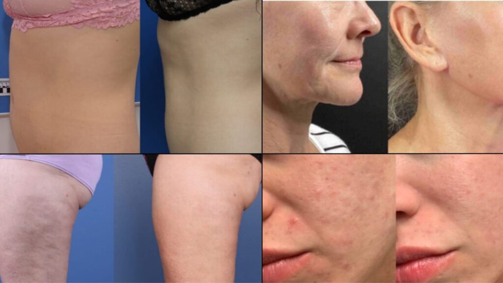 morpheus8_height_1500px